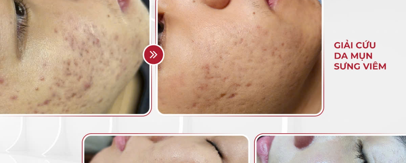 HIỆU QUẢ KIỂM CHỨNG GIẢI QUYẾT 80% VẤN ĐỀ VỀ DA 